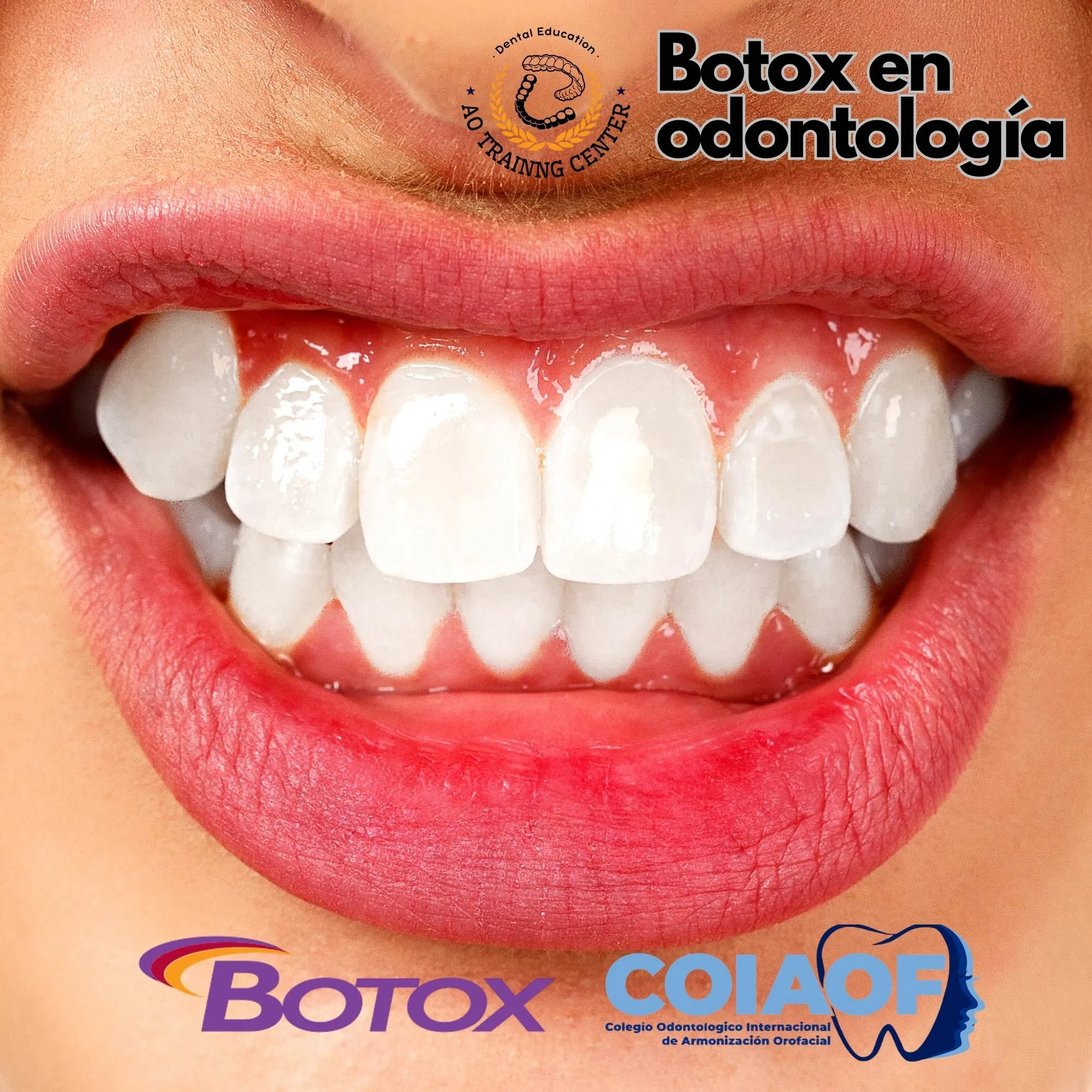 BOTOX EN ODONTOLOGIA