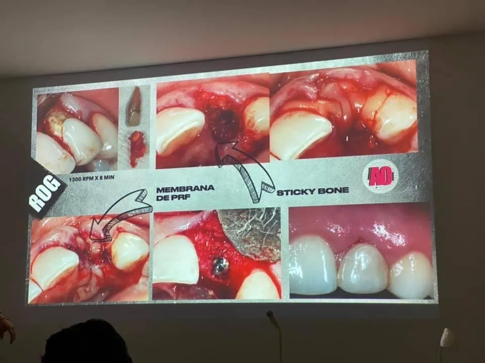 OTOPLASTIA 