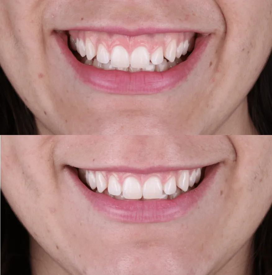 SONRISA GINGIVAL 